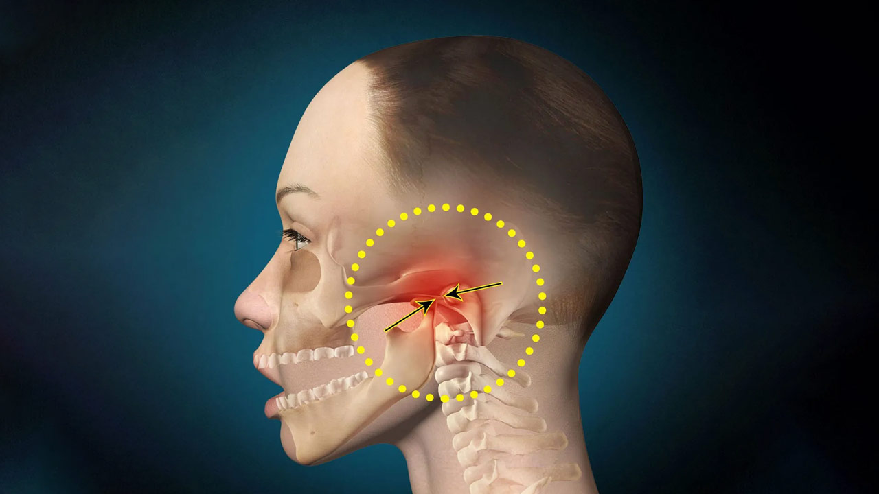 Mandíbula estalando e dor de cabeça estão entre sintomas da DTM